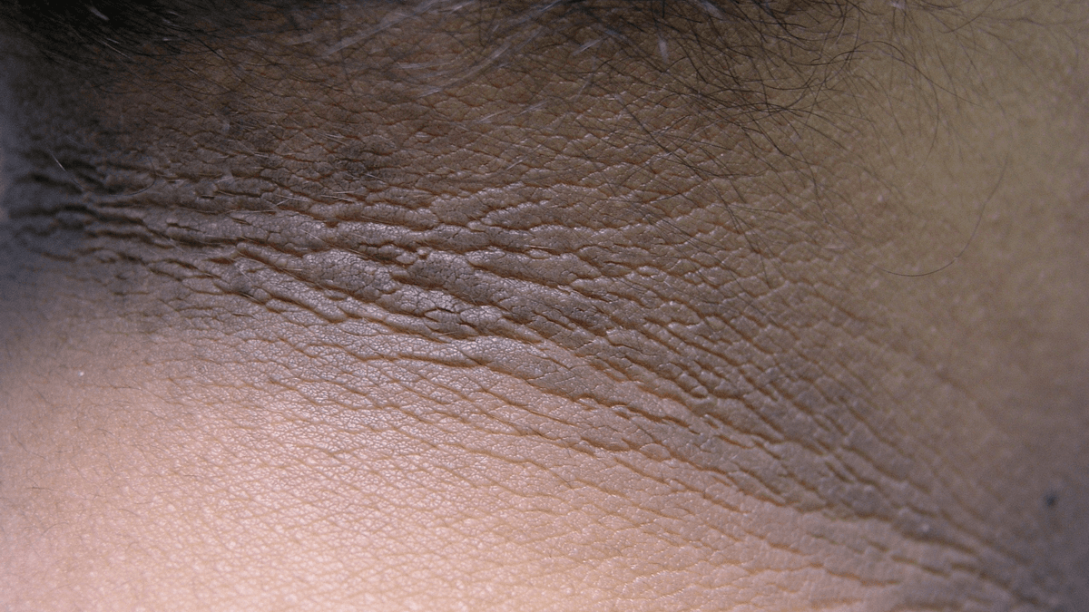 Acanthosis Nigricans Treatment treatment at NFSC, Mumbai
