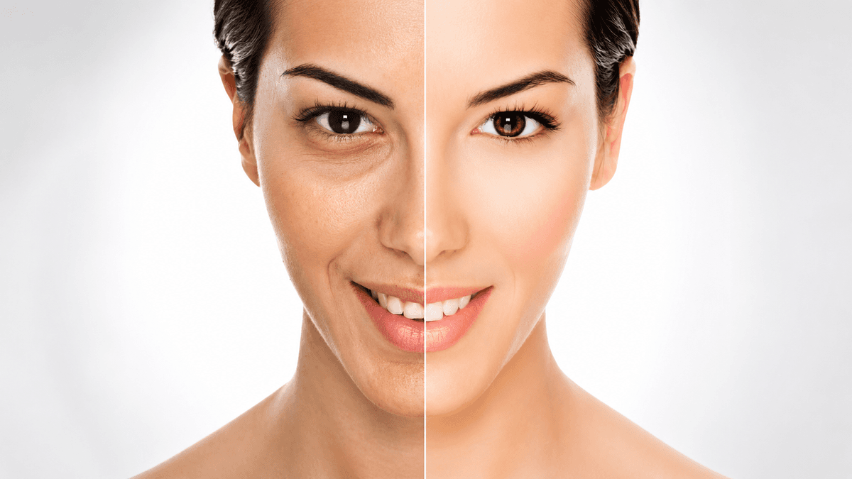 Cosmelan Peel treatment at NFSC, Mumbai
