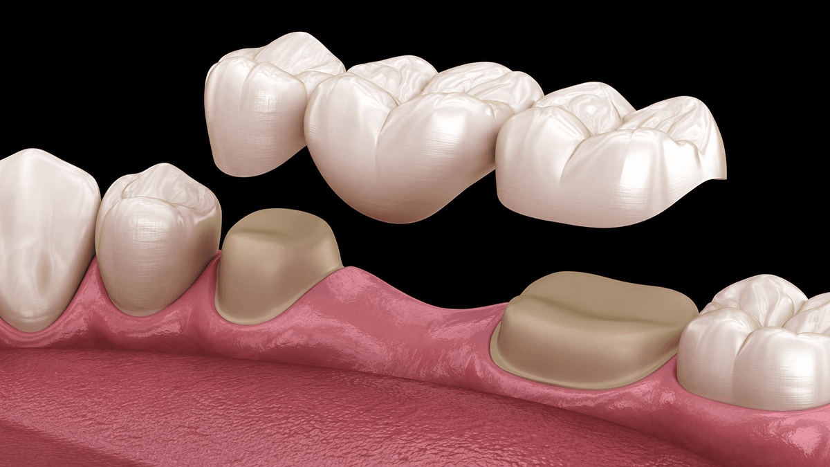 Crown & Bridges treatment at NFSC, Mumbai