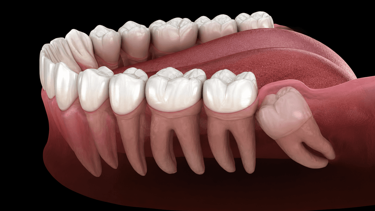 Wisdom Tooth Removal treatment at NFSC, Mumbai