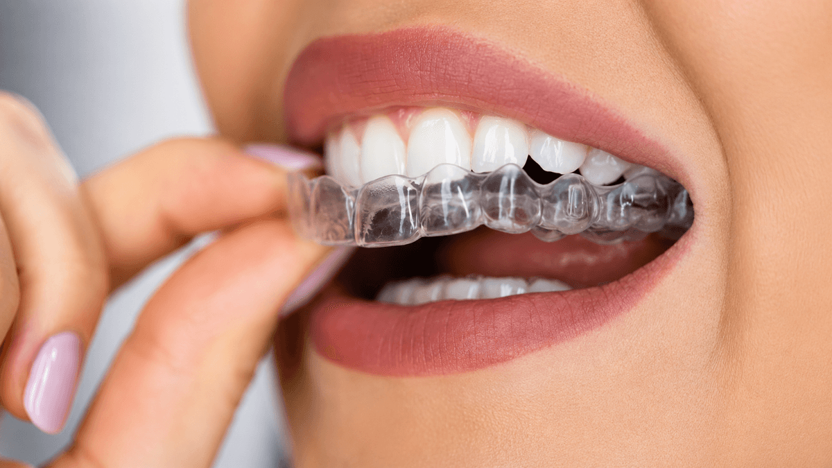 Aligners & Braces treatment at NFSC, Mumbai