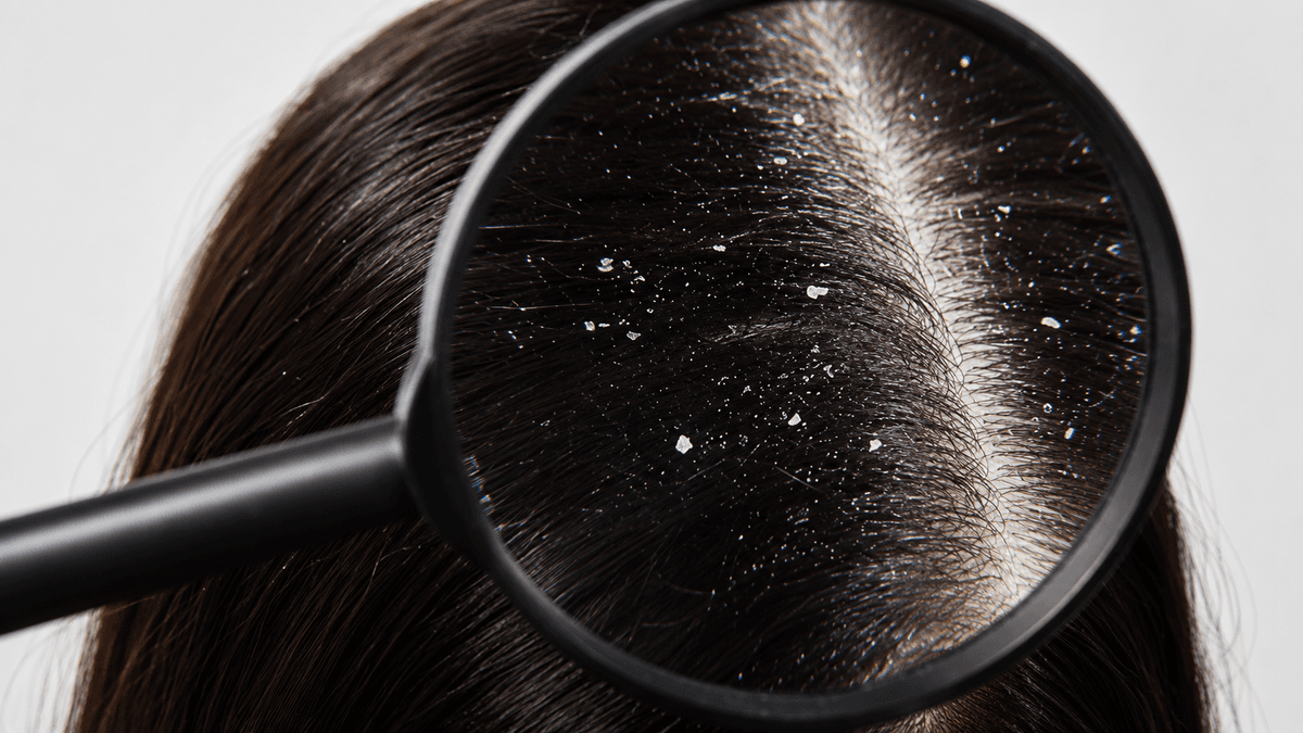 Dandruff & Scalp Treatment treatment at NFSC, Mumbai