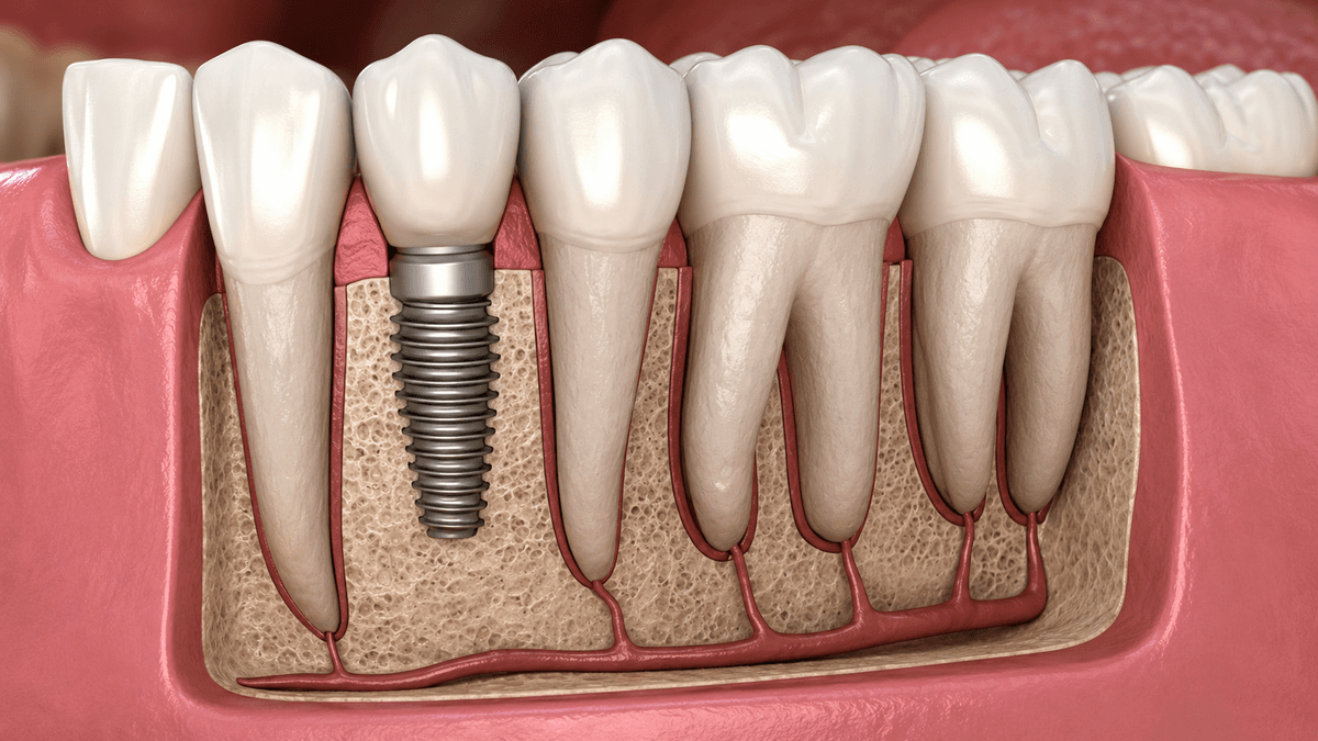 Dental Implants treatment at NFSC, Mumbai