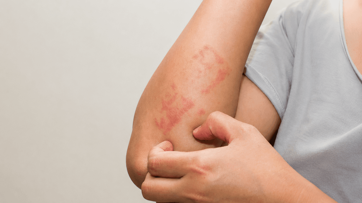 Eczema Treatment treatment at NFSC, Mumbai