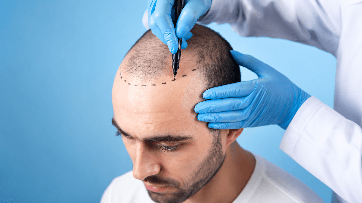 Hair Transplant Surgery treatment at NFSC, Mumbai