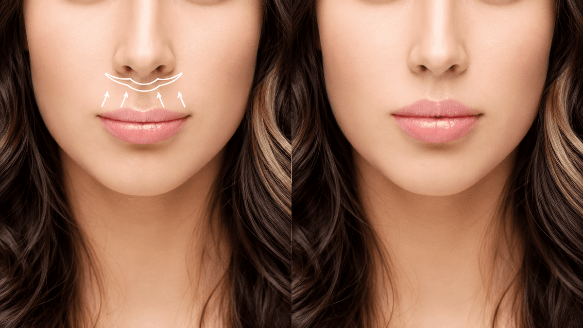 Lip Lift Surgery treatment at NFSC, Mumbai