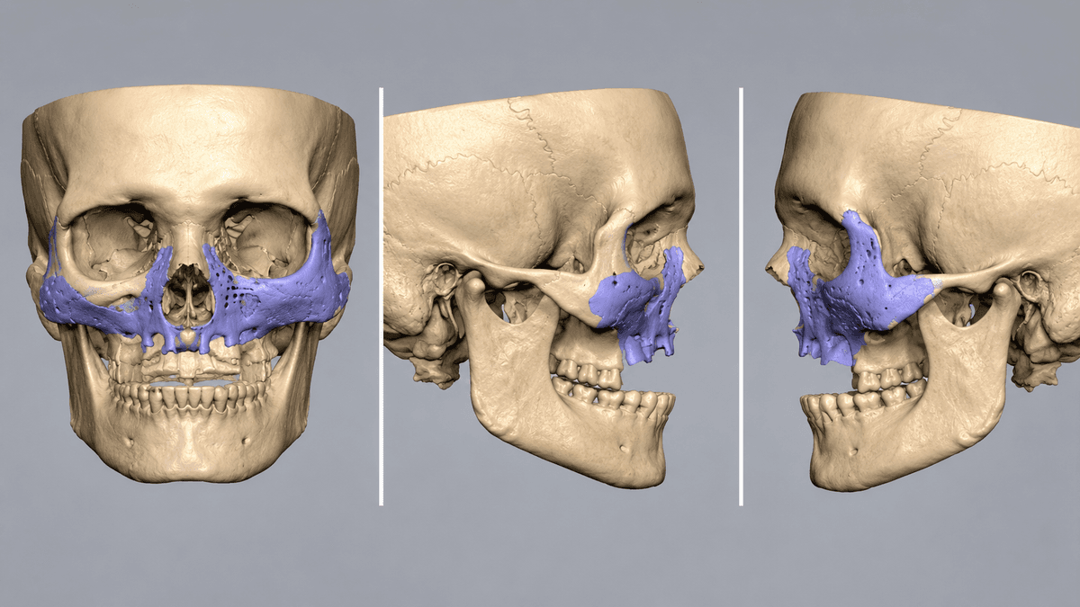 Patient Specific Implants (PSI) treatment at NFSC, Mumbai