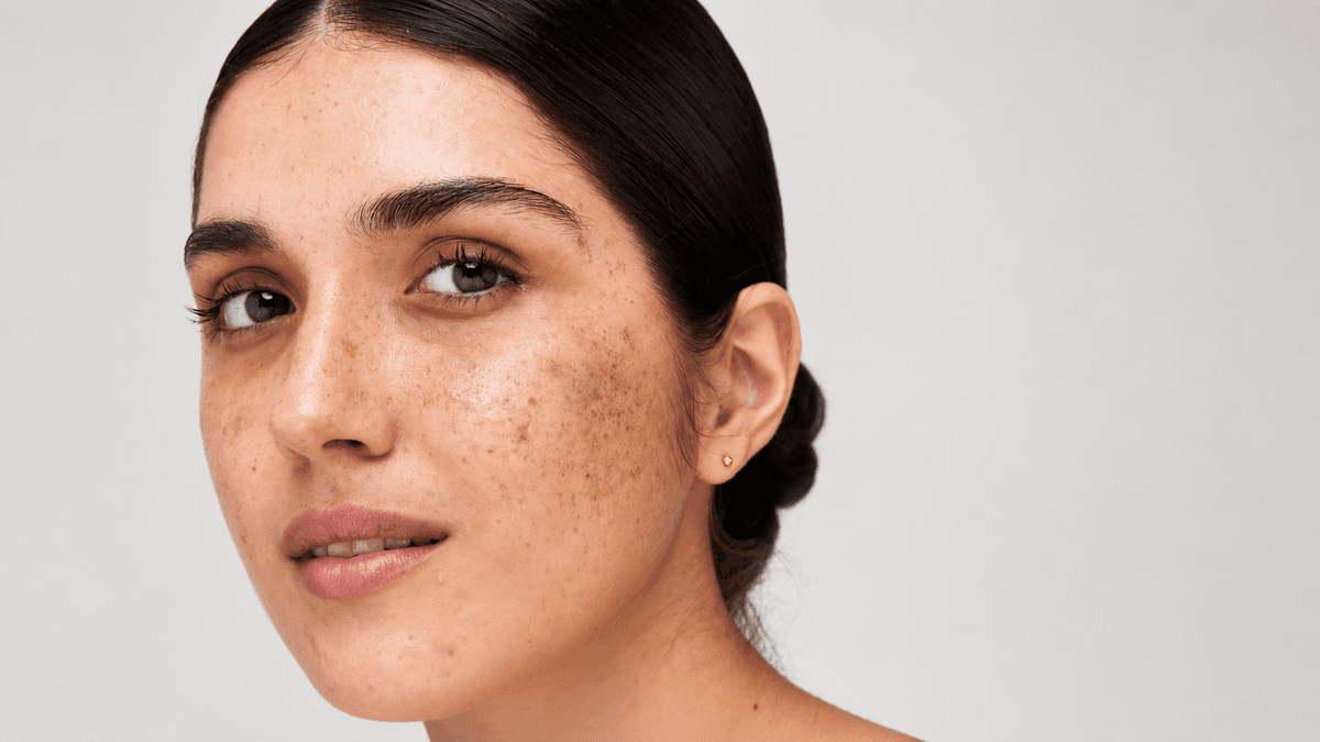 Pigmentation treatment treatment at NFSC, Mumbai