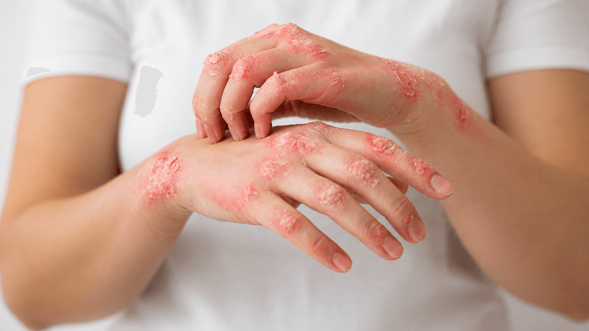 Psoriasis Treatment treatment at NFSC, Mumbai