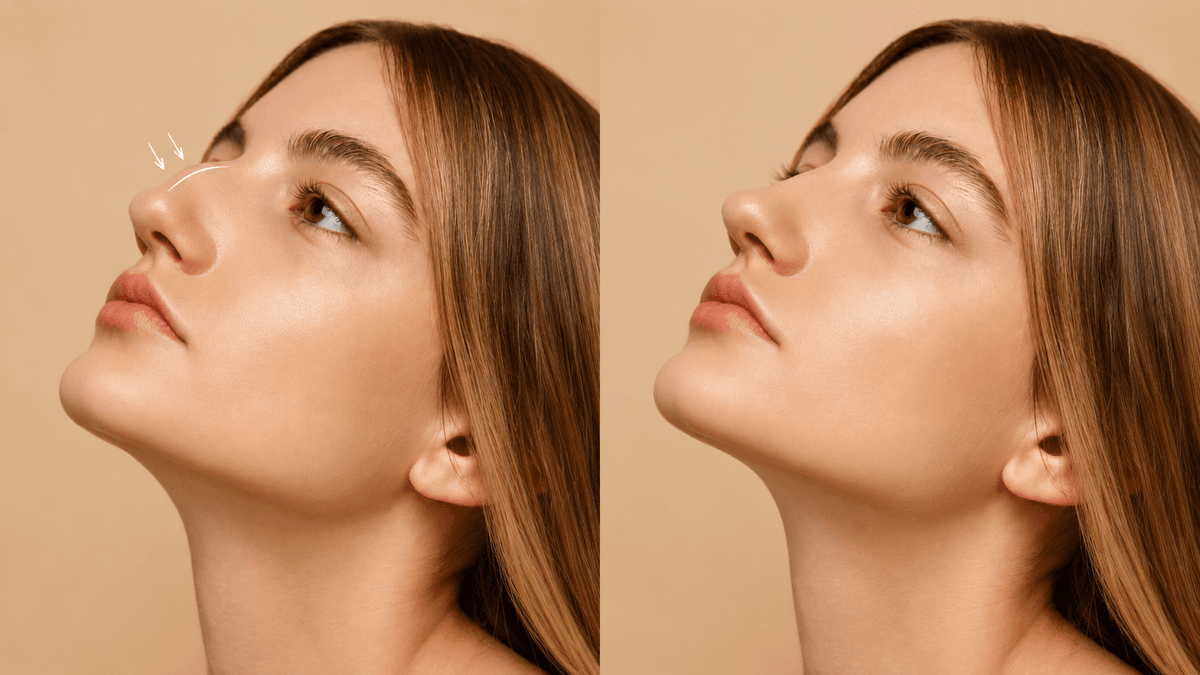 Rhinoplasty (Nose Surgery) treatment at NFSC, Mumbai