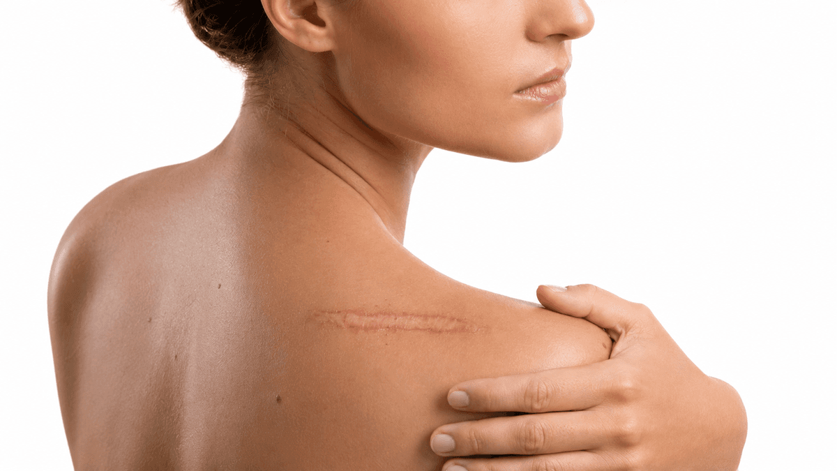Scar Revision Surgery treatment at NFSC, Mumbai