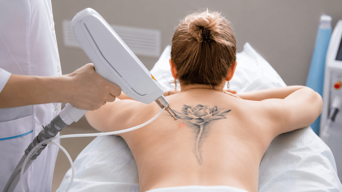 Tattoo Removal treatment at NFSC, Mumbai