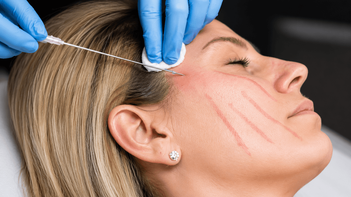 Thread Lift treatment at NFSC, Mumbai