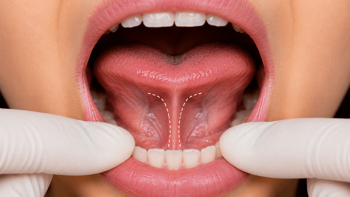 Tongue Tie (Frenectomy) Surgery treatment at NFSC, Mumbai