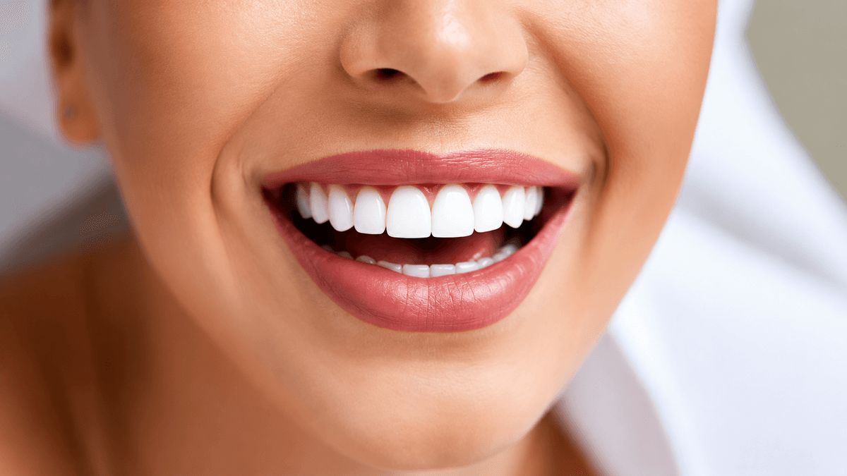 Veneers & Laminates (Hollywood Smile) treatment at NFSC, Mumbai