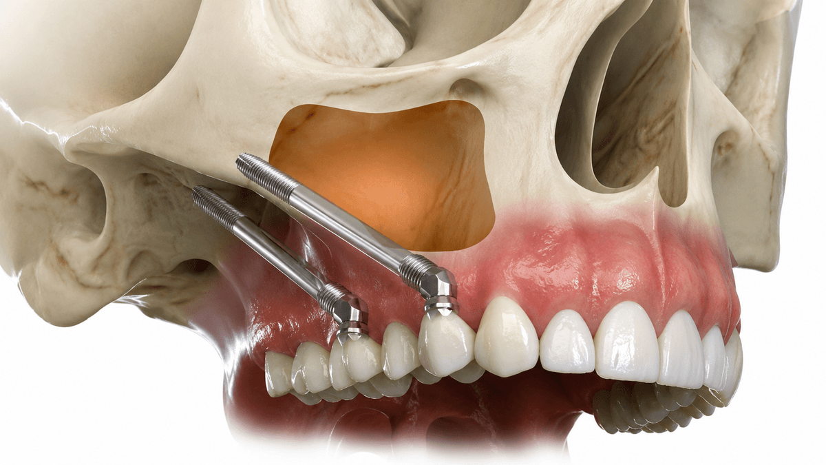 Zygomatic & Pterygoid Implants treatment at NFSC, Mumbai